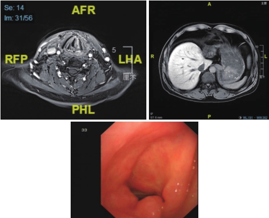 图5 喉MRI及腹部MRI（治疗结束后半年）.jpg